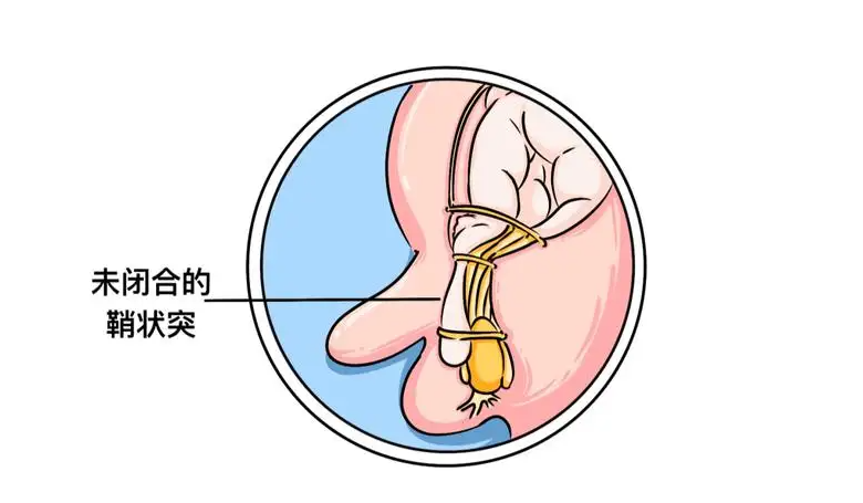 第一,新生兒鞘膜積液表現為精索腹膜鞘未完全閉塞,積聚形成積液,這時